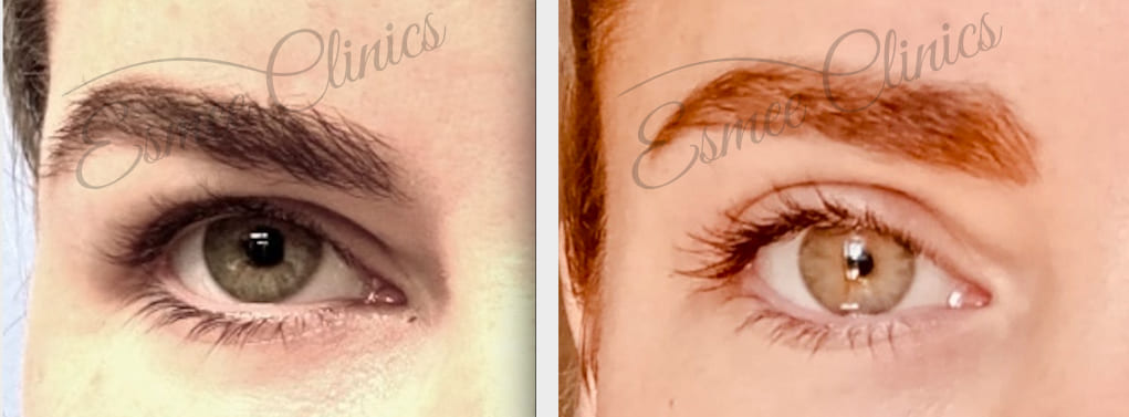 Before and After img